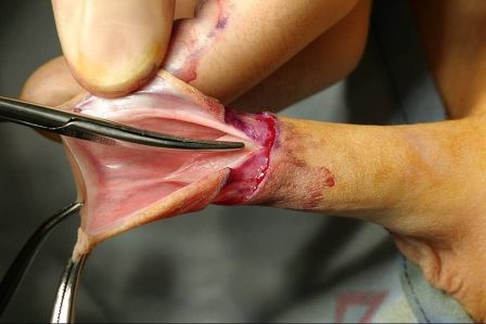 Circuncision 2
